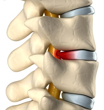 hernia-de-disco-causas-sintomas